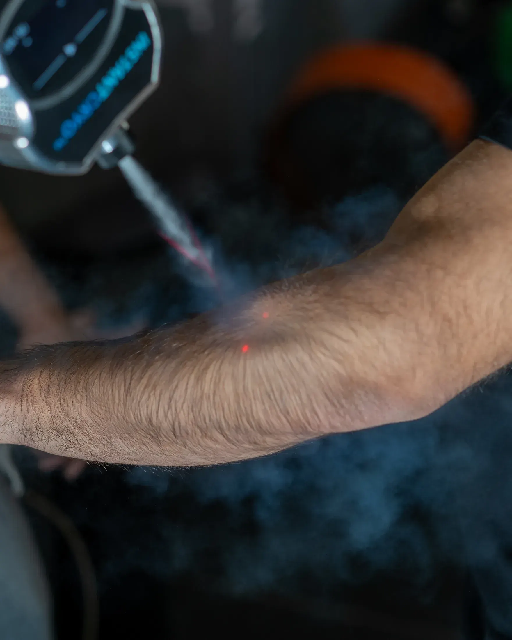 InstantCryo device treating a forearm